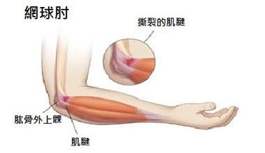 什么原因容易患網(wǎng)球肘