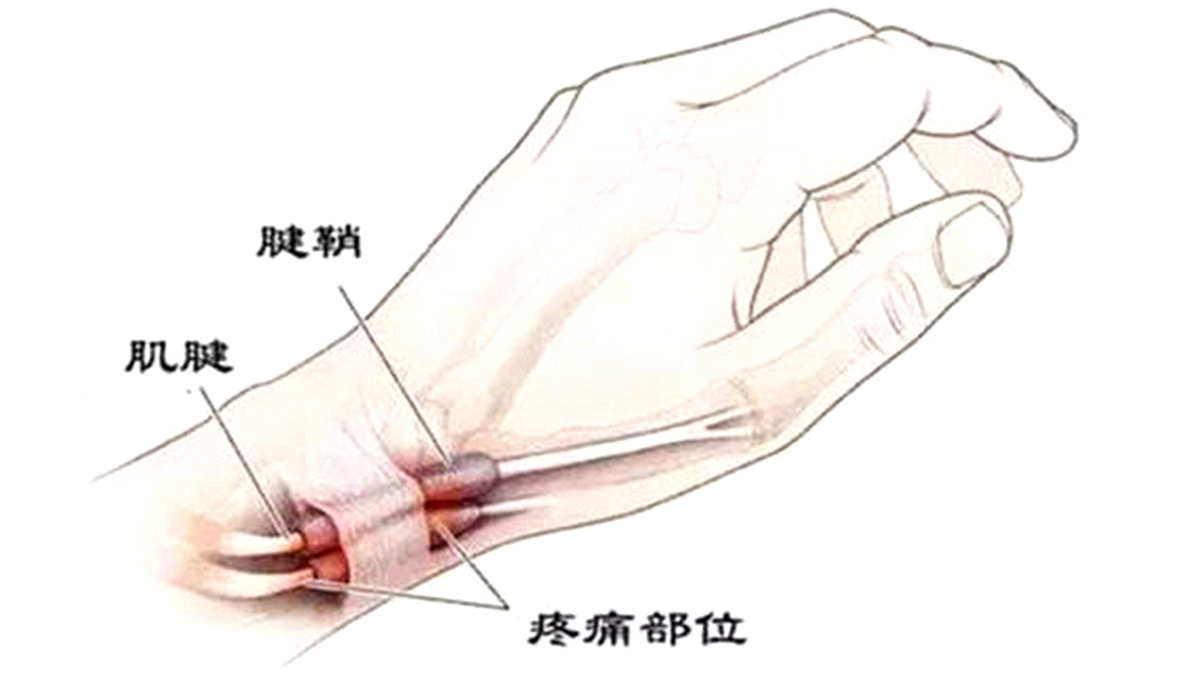 手腕酸痛的原因什么?怎么辦？