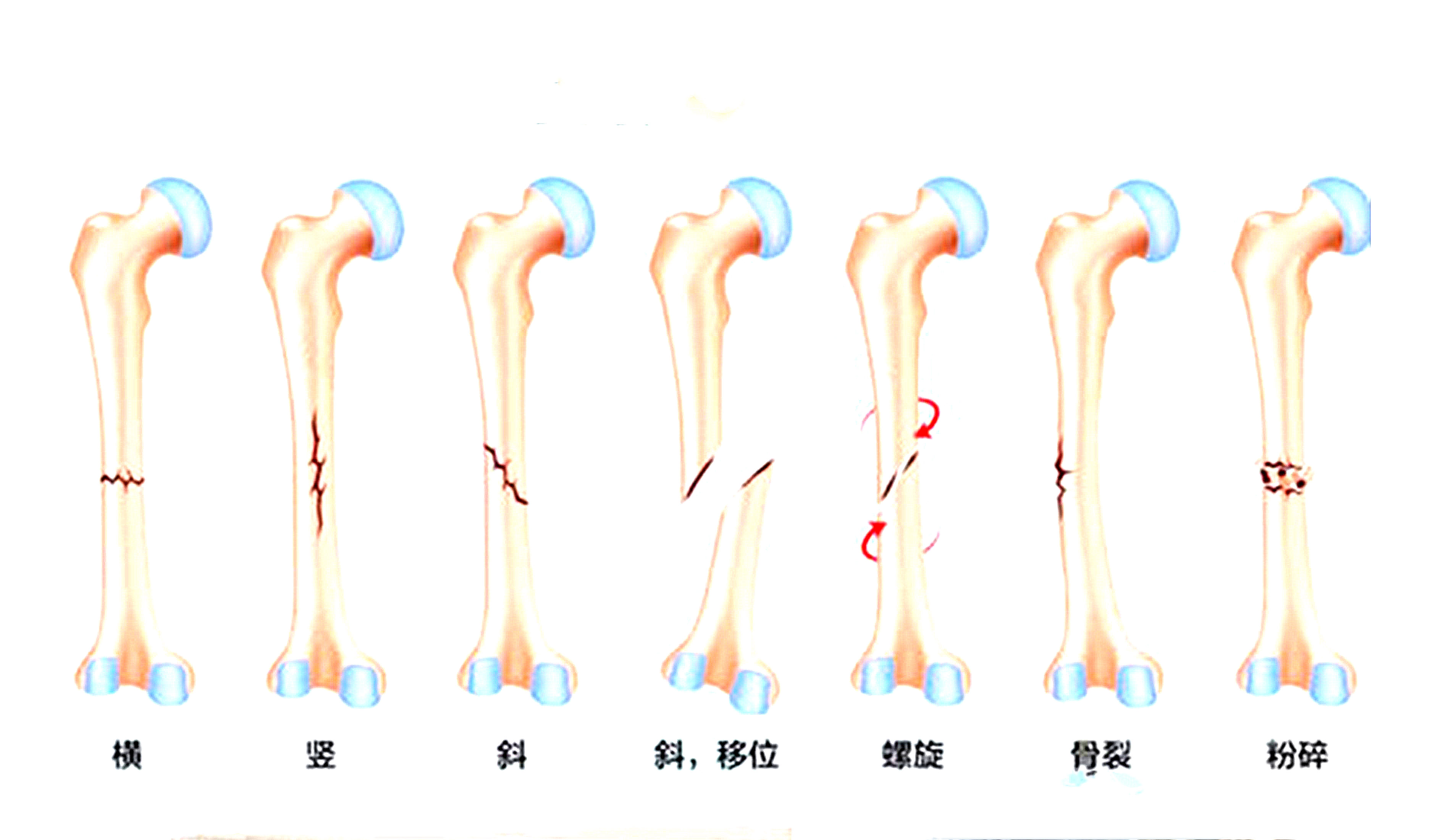 骨裂是骨折嗎？